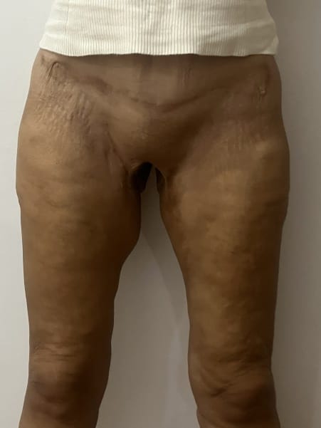 Thigh Lift both Medial and Vertical with Thighplasty and Liposuction at Best Plastic Surgery Egypt