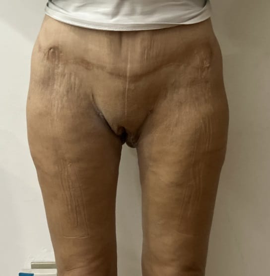 Thigh Lift both Medial and Vertical with Thighplasty and Liposuction at Best Cosmetic Surgery Egypt