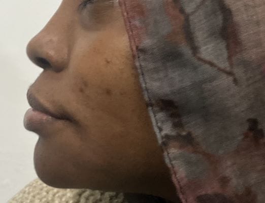 Liposculpture and Chin implants for Thin Pointed Chin and Jawline Definition at Best Plastic Surgery Egypt