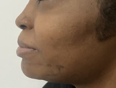 Thin Pointed Chin for chin Implants and Jawline Definition at Best Aesthetic Surgery Egypt