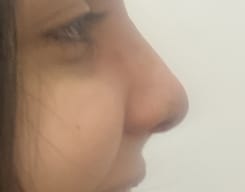 Nose Tip Rhinoplasty (6) Nose hump and Bony dorsum for Open Rhinoplasty at Best Cosmetic Surgeon