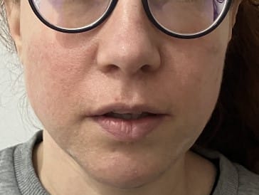 Cheek Fillers and Chin Hyaluronic acid fillers to enhance cheeks and round up the chin at Best Plastic Surgery Egypt