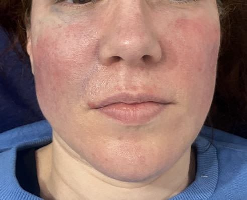 Cheek Fillers and Chin Hyaluronic acid fillers to enhance cheeks and round up the chin at Best Cosmetic Surgery Egypt