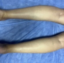 Thin legs treated by Calf Silicon Implants under the fascia at Best Plastic Surgery in Egypt