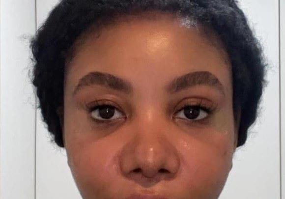 Cheek and malar implant replacement for sunken cheeks and asymmetric face at Best Cheekbone Surgery Egypt