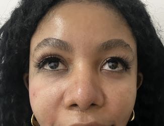 Cheek and malar implant replacement for sunken cheeks and asymmetric face at Best Face Surgery Egypt