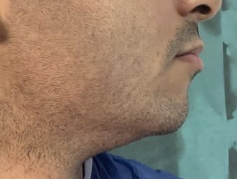 Chin Augmentation and Jawline Definition by Chin Implants at best Plastic Surgery Egypt