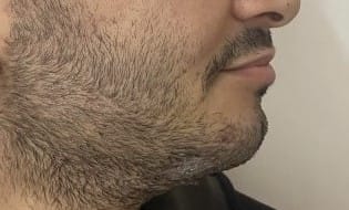 Chin Augmentation and Jawline Definition by Chin Implants at best Cosmetic Surgery Egypt