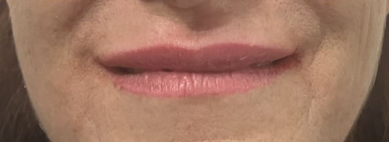 Lip Fillers Restylane, juvederm, and Teoxane for Thin Tapering Upper Lip at Best Cosmetic Surgery Egypt