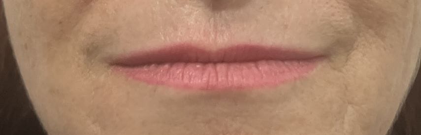 Lip Fillers Restylane, juvederm, and Teoxane for Thin Tapering Upper Lip at Best Plastic Surgery Egypt