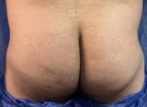 Brazilian Butt Lift BBL with Fat Grafting to Fill Depressions and give butt a rounded contour at Best Cosmetic Surgery Egypt
