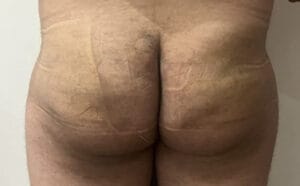 Brazilian Butt Lift BBL with Fat Grafting to Fill Depressions and give butt a rounded contour at Best Plastic Surgery Egypt