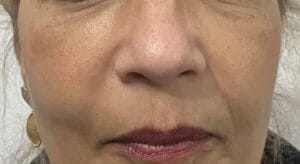 Asymmetric Cheeks fro Cheek fillers treated by Cheek Implants at Best Cosmetic Surgery Egypt