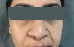 Full Nose iob and correction of wide nasal openings after Cleft Lip Nose Deformity at Best Plastic Surgery Egypt