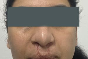 Full Nose iob and correction of wide nasal openings after Cleft Lip Nose Deformity at Best Cosmetic Surgery Egypt