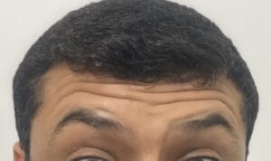 Dysport and Teoxane for Dynamic and Static Forehead deep wrinkles at Best Plastic Surgery Egypt