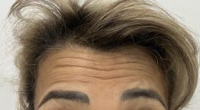Dysport to treat Deep Forehead wrinkles and strong muscles at Best Plastic Surgery Egypt