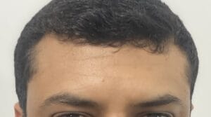 Dysport and Teoxane for Dynamic and Static Forehead deep wrinkles at Best Cosmetic Surgery Egypt