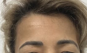 Dysport to treat Deep Forehead wrinkles and strong muscles at Best Cosmetic Surgery Egypt