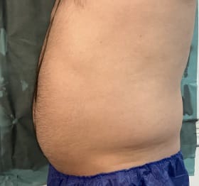 Tummy and Waist liposculpture with 6-pack creation at Best Cosmetic Surgery Egypt