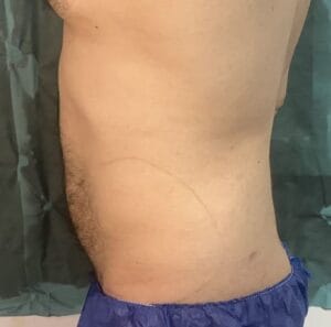 Tummy and Waist High Definition Smart Vaser Liposuction with 6-pack creation at Best Plastic Surgery Egypt