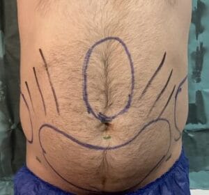Tummy and Waist liposculpture with 6-pack creation at Best Plastic Surgery Egypt