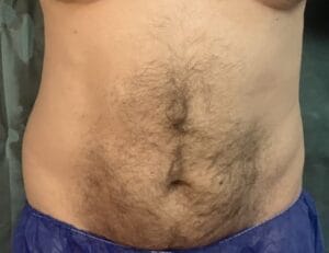 Tummy and Waist liposculpture with 6-pack creation at Best Aesthetic Surgery Egypt