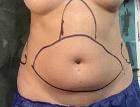 Bulging Belly and Fatty Waist treated by Tummy Contouring and Waist Definition using High Definition Liposuction at Best Plastic Surgery Egypt
