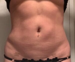 Bulging Belly and Fatty Waist treated by Tummy Contouring and Waist Definition using High Definition Liposuction at Best Cosmetic Surgery Egypt