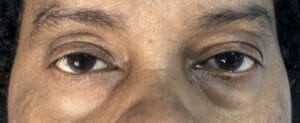 Blepharoplasty through Inside of the Lower Eyelid to Remove Eyelid Bags at Best Plastic Surgery Egypt