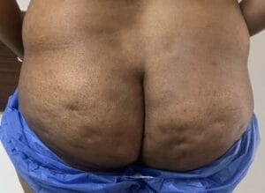 Smart Vaser Liposculpture to reduce Butt Size and shape at Best Plastic Surgery Egypt
