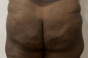 Smart Vaser Liposculpture to reduce Butt Size and shape at Best Aesthetic Surgery Egypt