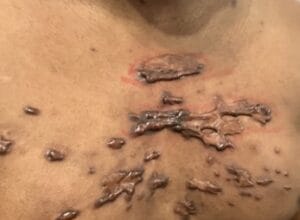 Itchy and painful keloids in the Chest of a Nigerian male treated at Best Cosmetic Surgery Egypt