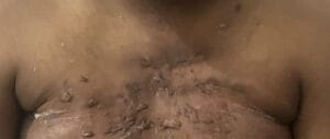Itchy and painful keloids in the Chest of a Nigerian male treated at Best Plastic Surgery Egypt