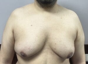 Grade 4 Gynecomastia and male Chest enlargement treated by Vaser Liposuction at Best Plastic Surgery Egypt