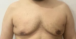 Grade 4 Gynecomastia and male Chest enlargement treated by Vaser Liposuction at Best Aesthetic Surgery Egypt