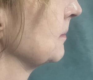 Jawline Definition and Removal of Jowls and Chin Implants at Best Plastic Surgery Egypt
