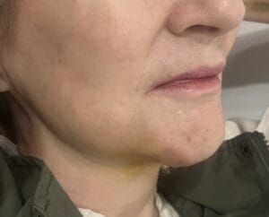 Jawline Definition and Removal of Jowls and Chin Implants at Best Aesthetic Surgery Egypt