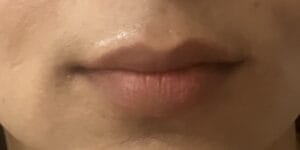 Lip Enlargement by Teoxane Filler to give the lips a full sexy look at Best Plastic Surgery Egypt