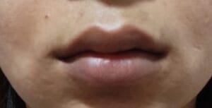 Lip Enlargement by Teoxane Filler to give the lips a full sexy look at Best Cosmetic Surgery Egypt
