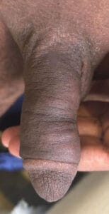 Combination of Micro Fat and Nano Fat to increase the girth of a long thin penis at Best Cosmetic Surgery Egypt