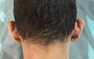 Prominent Bat Ears and Cartilage Deformity for Otoplasty and bat ear correction at Best Plastic Surgery Egypt