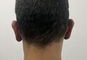 Prominent Bat Ears and Cartilage Deformity for Otoplasty and bat ear correction at Best Cosmetic Surgery Egypt