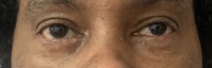 Blepharoplasty through Inside of the Lower Eyelid to Remove Eyelid Bags at Best Aesthetic Surgery Egypt