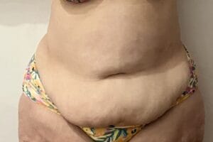 Secondary Tummy Tuck of Belly and waist and Love Handles following Vaser Liposuction for Lipedema at Best Plastic surgery Egypt