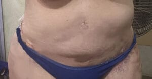 Secondary Tummy Tuck of Belly and waist and Love Handles following Vaser Liposuction for Lipedema at Best Cosmetic surgery Egypt