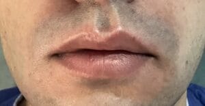 Upper Lip Reduction and Symmetry restoration for plump upper lip at Best Plastic Surgery Egypt