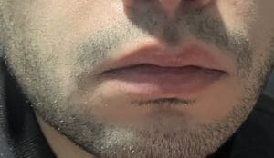 Upper Lip Reduction and Symmetry restoration for plump upper lip at Best Cosmetic Surgery Egypt