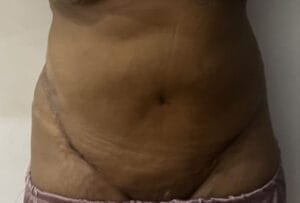 Lax sagging Tuumy with low belly button treated by Liposculpture and Tummy Tuck Abdominoplasty at Best Cosmetic Surgery Egypt
