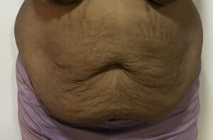 Lax sagging Tuumy with low belly button treated by Liposculpture and Tummy Tuck Abdominoplasty at Best Plastic Surgery Egypt